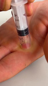 682K views · 1.7K reactions | Easily remove splinters with this hack! | Pixel Pop | Facebook