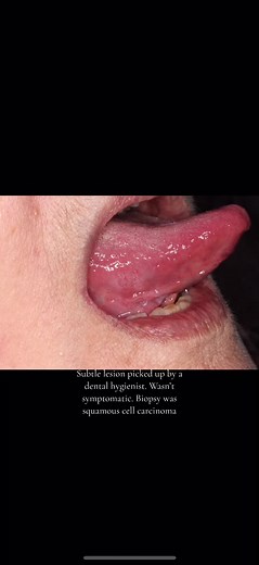 Understanding Tongue Cancer: Symptoms, Diagnosis, and Treatment