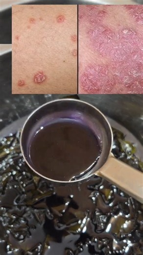 சொரியாசிஸ் & அரிப்பு பிரச்சனையா? 🌿 Vetpalai Oil Soap & Kuppaimeni Soap #psoriasis #skincare #shorts
