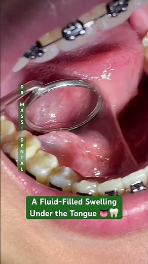 RANULA :A Fluid-Filled Swelling Under the Tongue 👅🦷