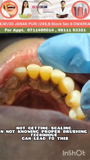 Teeth Properly Clean Nahi Karte? 😱 Phir Ye Ho Sakta Hai! | Dentist Warning #dentist #viral #trending