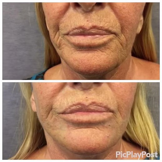 Hilos Tensores Happy Lift - Antes y después - Clinica CIME Barcelona y Badalona