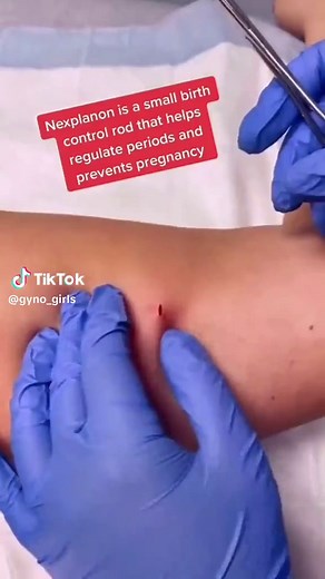 Nexplanon removal made easy! #nexplanon #nexplanonremoval #nexplanoninsertion #birthcontrol #obgyn #womenshealth #gynecology #gynecologist