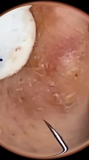 #pimple #pimpleremover #acne #treatment #relaxingvideos #relaxing #usa #extractions #satisfyingvideo