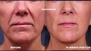 Dramatic Facial Rejuvenation w/ CO2 Laser Resurfacing