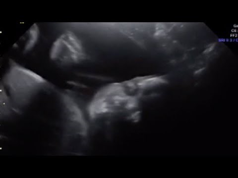Incredible Moment Unborn Baby Waves At Mum