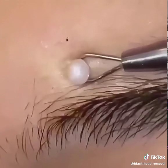 #blackhead #blackheads #blackheadextraction #blackheadremovals #head #cleaning #beautyroutine #satisfying #removal #visage #routine #soin #soinvisage #soins #satisfyingvideo #satisfaction #pimple #pimpleremove #acne #acneskin