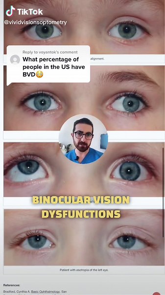 Understanding Binocular Vision Dysfunction: Symptoms, Causes, and Solutions