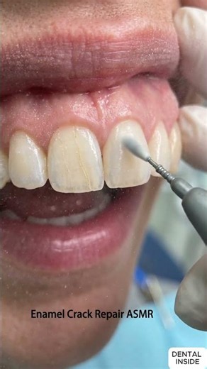 How Enamel Crack Repair Is Done 🦷 Visible Tooth Fracture Sealing Explained