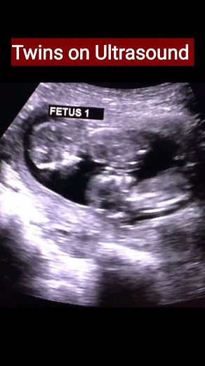 Monoamniotic twins occur when a single fertilized ovum (egg) results in identical twins that share a common placenta and amniotic sac. Monoamniotic twins are very uncommon, representing approximately one percent of identical twins and less than 0.1 percent of all pregnancies. #monozygotictwins #monoamniotic #monoamniotictwins #monozygotictwin #twinbabies #twin #twinlife #pregnancyscan | Dr home - Dr shikha Agarwal