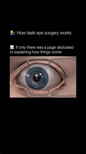 Finest Inventions on Instagram: "LASIK eye surgery works by reshaping the cornea to correct vision problems. First, the surgeon creates a thin flap in the cornea using a microkeratome or a femtosecond laser. 👁️ This flap is then lifted to expose the underlying corneal tissue. An excimer laser is used to remove precise amounts of corneal tissue to reshape the cornea, allowing light to be properly focused onto the retina. After the cornea is reshaped, the flap is laid back into place, where it ad