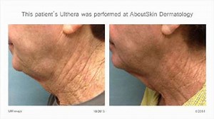 What Is Ultherapy and What Could It Do For Me?