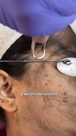 How Carbon Q-Switch Laser Works: Skin Benefits & Treatment Explained | Dr. Sarin |
