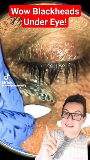 Crazy BLACKHEAD REMOVAL UNDER EYE - How Did This Happen #shorts