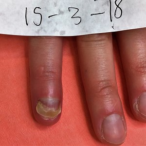 Successfully Repairing Damaged Finger Nail Bed