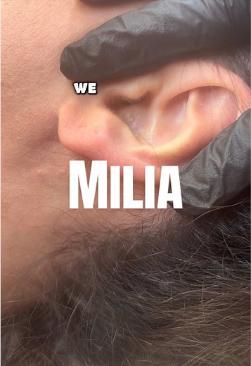 Giant Ear Milia Extraction: Quick Ear Check During Facials