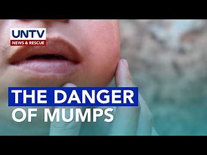 MUMPS: Learn Symptoms, Risks, and Complications if Untreated