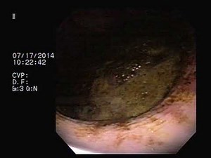 Equine Stomach with ulcers and bot fly larvae