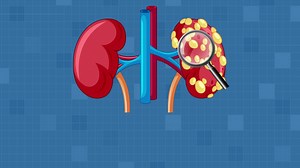 Animated sequence shows kidney cancer development from healthy cells to tumor growth, with clear visuals | Premium Stock Video Footage