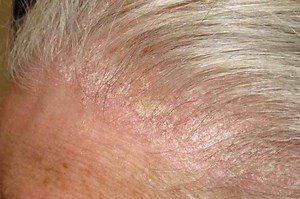 What are the different types of psoriasis? | Emergency Live