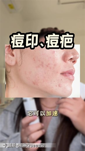 破解內包痘的秘密與保養技巧