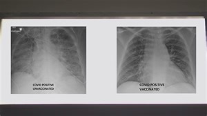 COVID-19 lung x-rays show difference vaccination can make