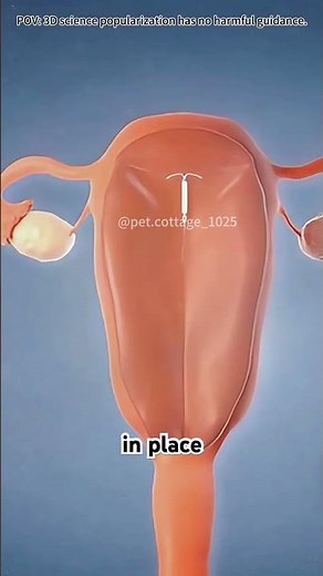 How intrauterine device IUD is inserted? #drone #theflash #space