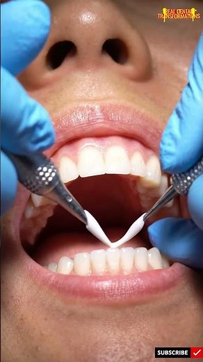 Hidden cavity between teeth fixed step by step — a satisfying natural tooth transformation!