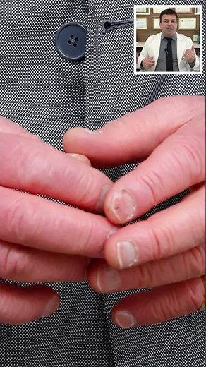 King Charles III: What is sausage finger disease? | #shorts #kingcharles