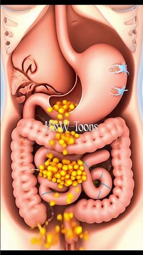 Dumping Syndrome: Rapid Gastric Emptying and Fluid Chaos #DumpingSyndrome #RapidGastricEmptying