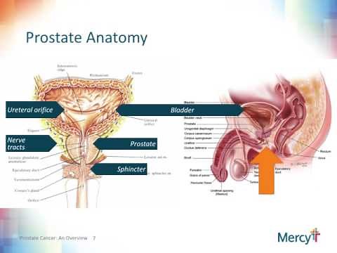 Prostate Cancer - Diagnosis and Treatment