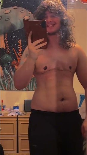 My top surgery results! #transgender