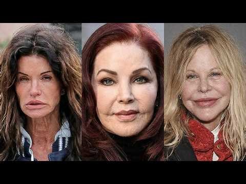 Celebrities Suffering With Pillow Face Before and After Photos