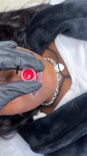 Lip Neutralization: First Session Results Revealed