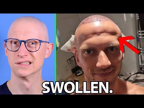 Forehead SWELLING After a Hair Transplant | Dr. Gary Linkov