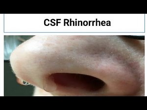CSF Rhinorrhea| Approach to CSF Rhinorrhea|