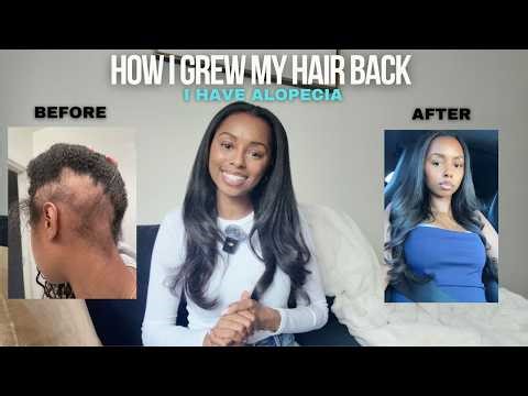 HOW I GREW MY HAIR BACK WITH ALOPECIA