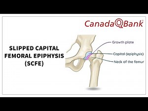 Slipped Capital Femoral Epiphysis (SCFE): Causes, Symptoms & Treatment | Orthopedics | CanadaQBank