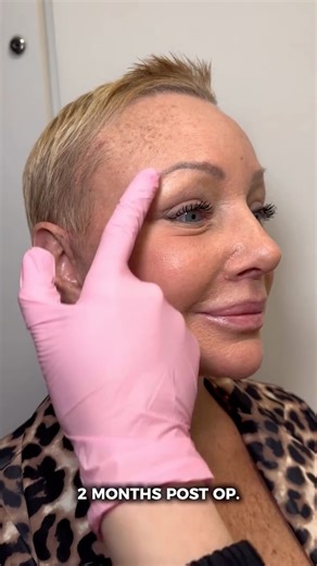 Plastic Surgeon Dr. Kassir on Instagram: "Our beautiful patient is 60 years young and just 1 month post-op. She came to us feeling that her appearance looked tired and aged, and wanted a refreshed, rejuvenated look that would make her feel confident when she looks in the mirror. She underwent a Deep Plane Face & Neck Lift, Endoscopic Brow Lift, Designer Rhinoplasty®, Upper & Lower Blepharoplasty, Fat Transfer to the Face, CO₂ treatment to the Face & Neck, and a Lip Lift - already revealing a mor