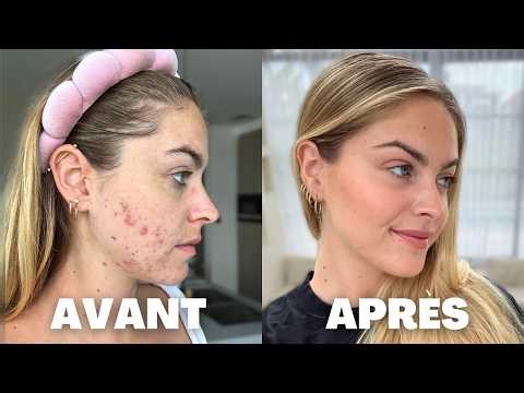 Comment j'ai éliminé mon acné en 6 mois (sans Roaccutane)