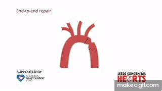 Coarctation of the Aorta: treatment on Make a GIF