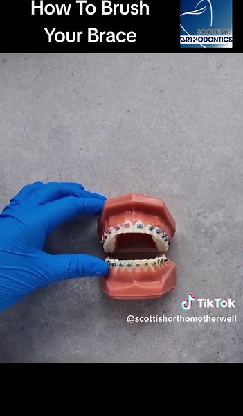 How To Brush Your Brace 🦷🪥 At Scottish Orthodontics we understand that your Oral Health is very important. It is especially important when having brace treatment. 😁 We always offer Oral Health advise to our patients and encourage a healthy life style. 😀 #oralhealth #dentist #scotland #orthodontics #braces #advice #foryou #brushingteeth #invisalign