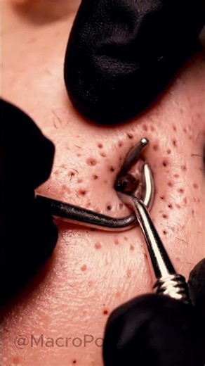 Macro Nose Blackhead Removal | Clinical 4K Extraction