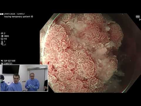 ESD for colonic LST by Dr. Faith Aslan and Dr. Muhammed Noor, 9th Saudi Live Endoscopy 2026, KFMC