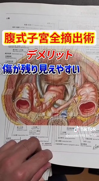 【子宮全摘】腟式・腹式の違いを簡単解説①☆ #子宮摘出後 #子宮摘出 #子宮全摘