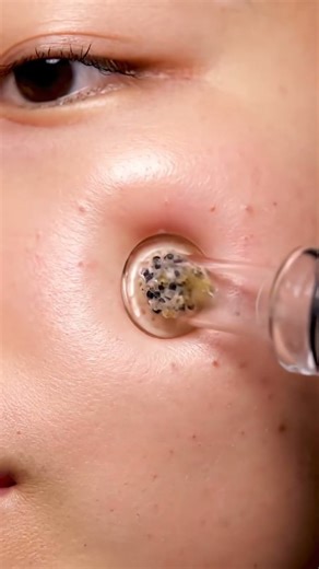 Deep Pore Gunk Extraction — So Relaxing