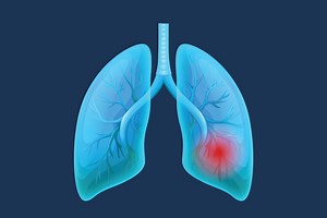 I Have the KRAS Mutation: What Does That Mean?