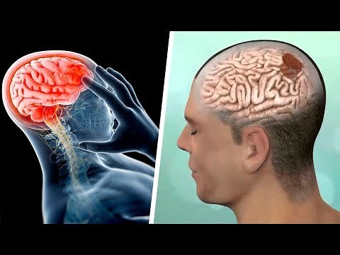 Why do I get stabbing pains in my head? [Head Stabbing Pains: These Are 5 Causes]