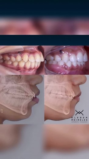 Understanding the Retraction of Anterior Teeth in Dentistry