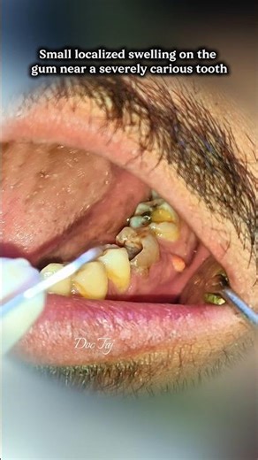 Gum Boil || Parulis || Dental Abscess || Sinus Tract || Non- Vital Tooth || RCT #doctaj #dentist